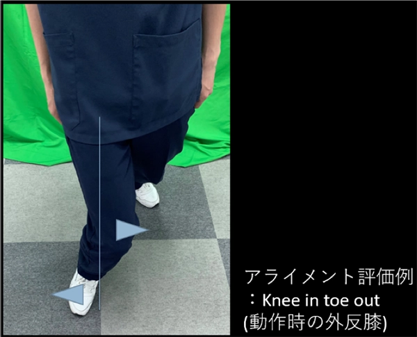 膝蓋骨脱臼の概要