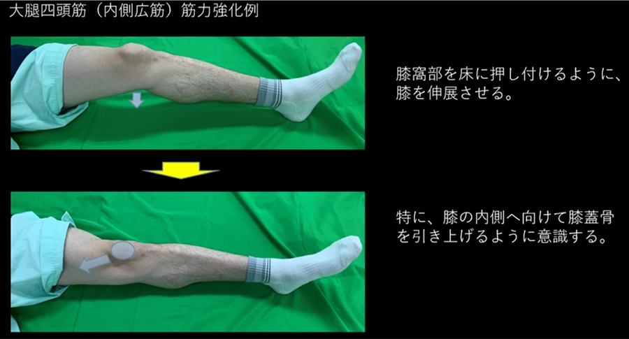 膝蓋骨脱臼の概要