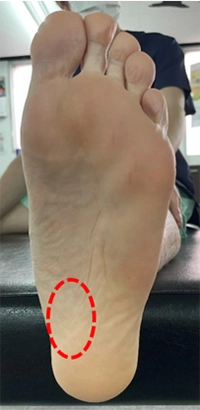 アキレス腱の早期リハビリ_足趾運動