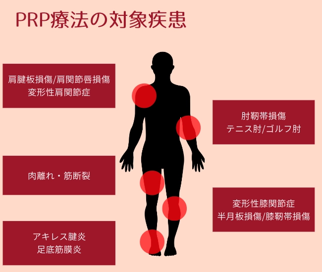 PRP療法の対象疾患