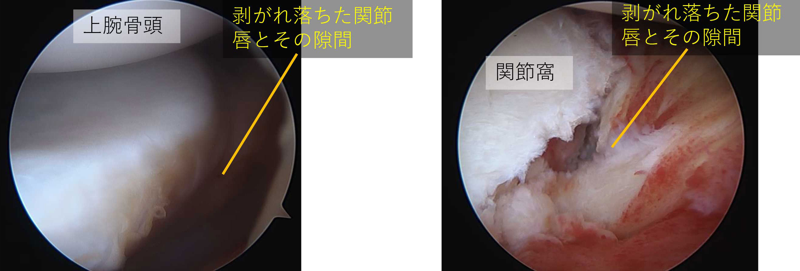 損傷部の確認　関節窩から関節唇が剥がれ落ちている