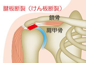 腱板断裂について