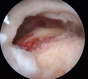 腱板断裂手術画像_腱板が剥がれ穴があいている様子