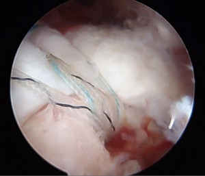 腱板断裂の手術画像_腱板に通した糸を骨に固定して終了