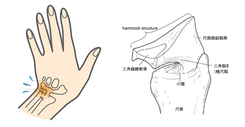 離断性骨軟骨炎（野球肘）