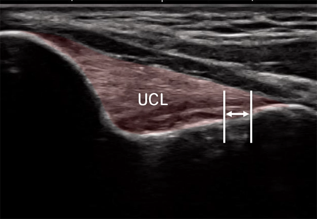 UCL損傷_超音波検査の正常な画像
