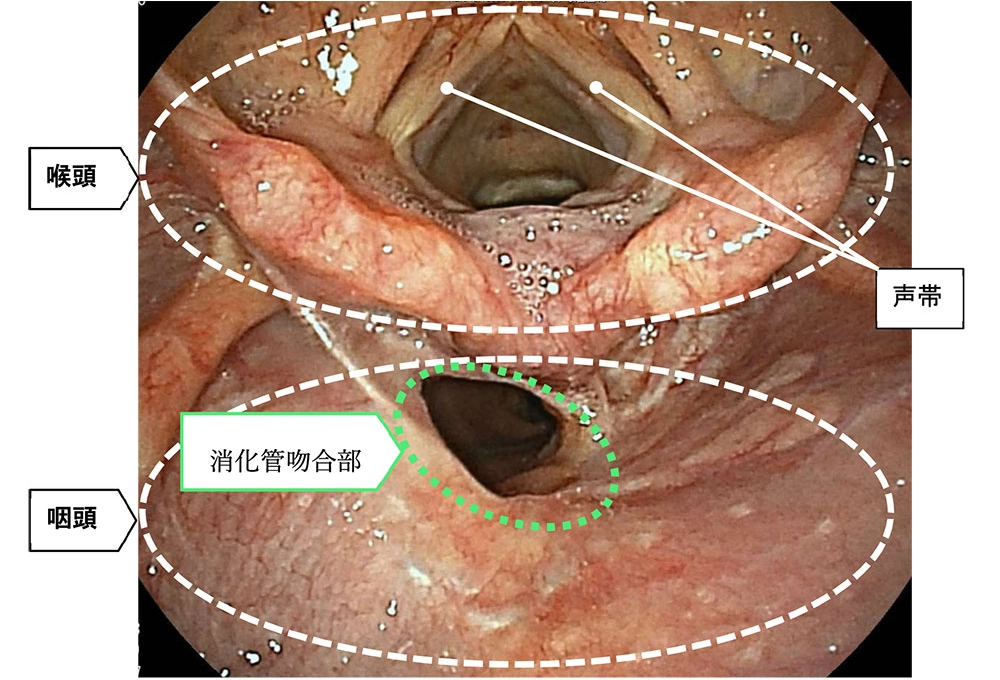 喉頭の温存手術_喉頭回転法を用いて手術を行った患者様の手術後の内視鏡の写真