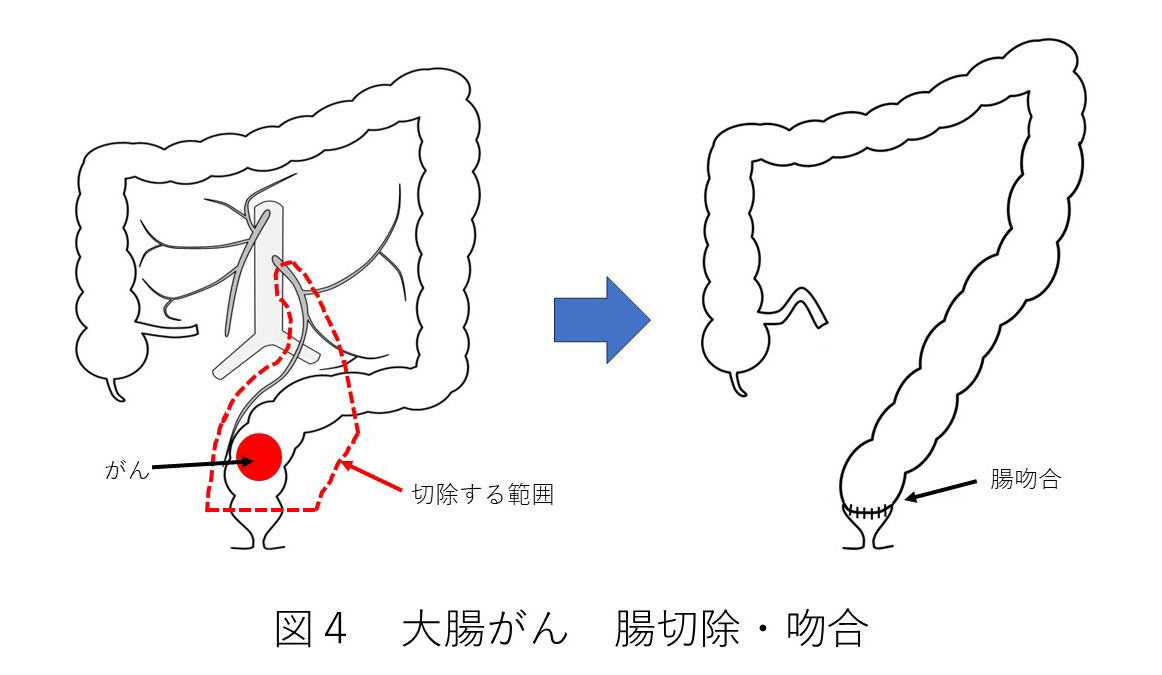 大腸がんの治療 切除範囲・吻合について