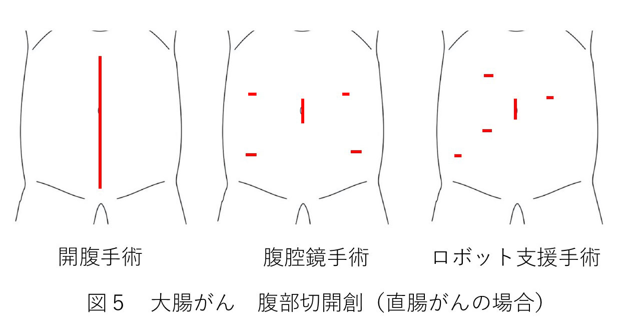 直腸がんの開腹手術・腹腔鏡手術・ロボット支援手術