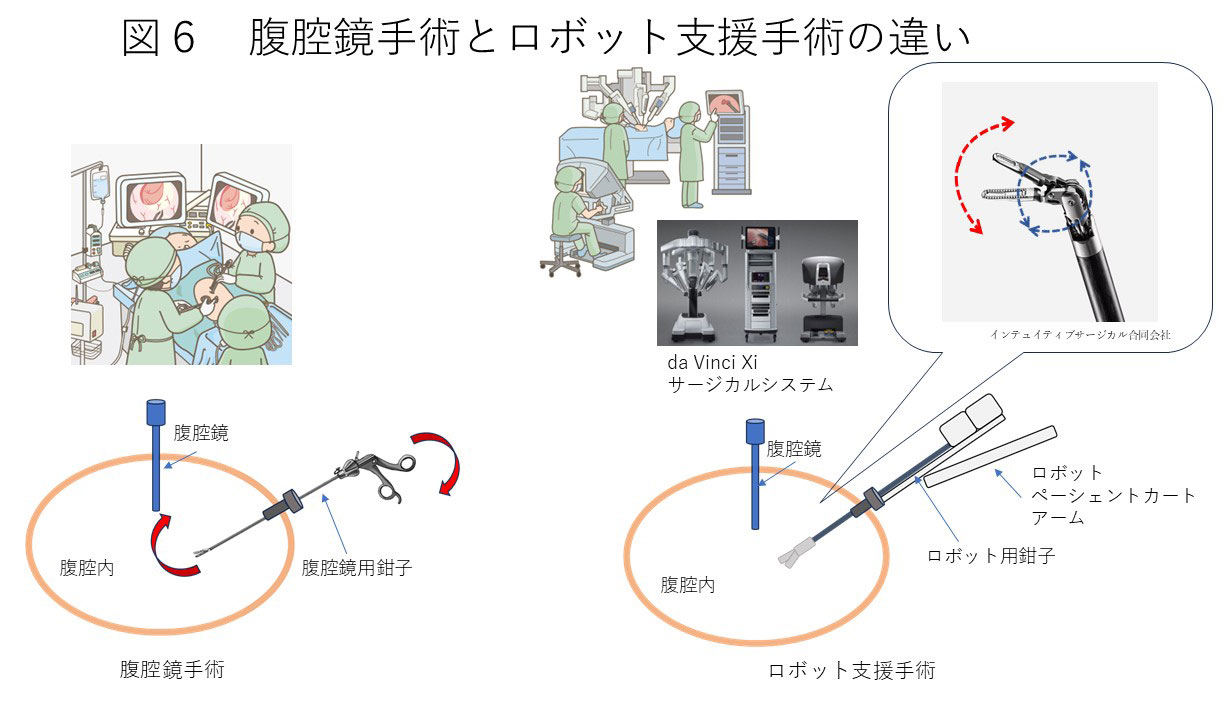 直腸がんの開腹手術・腹腔鏡手術・ロボット支援手術