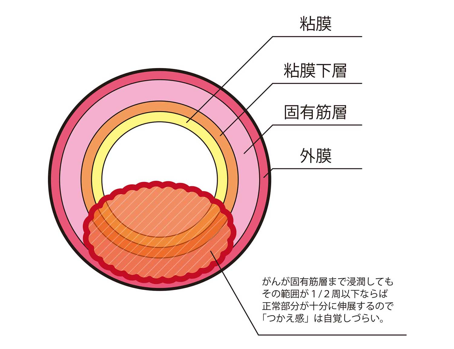 食道のがん組織の浸潤