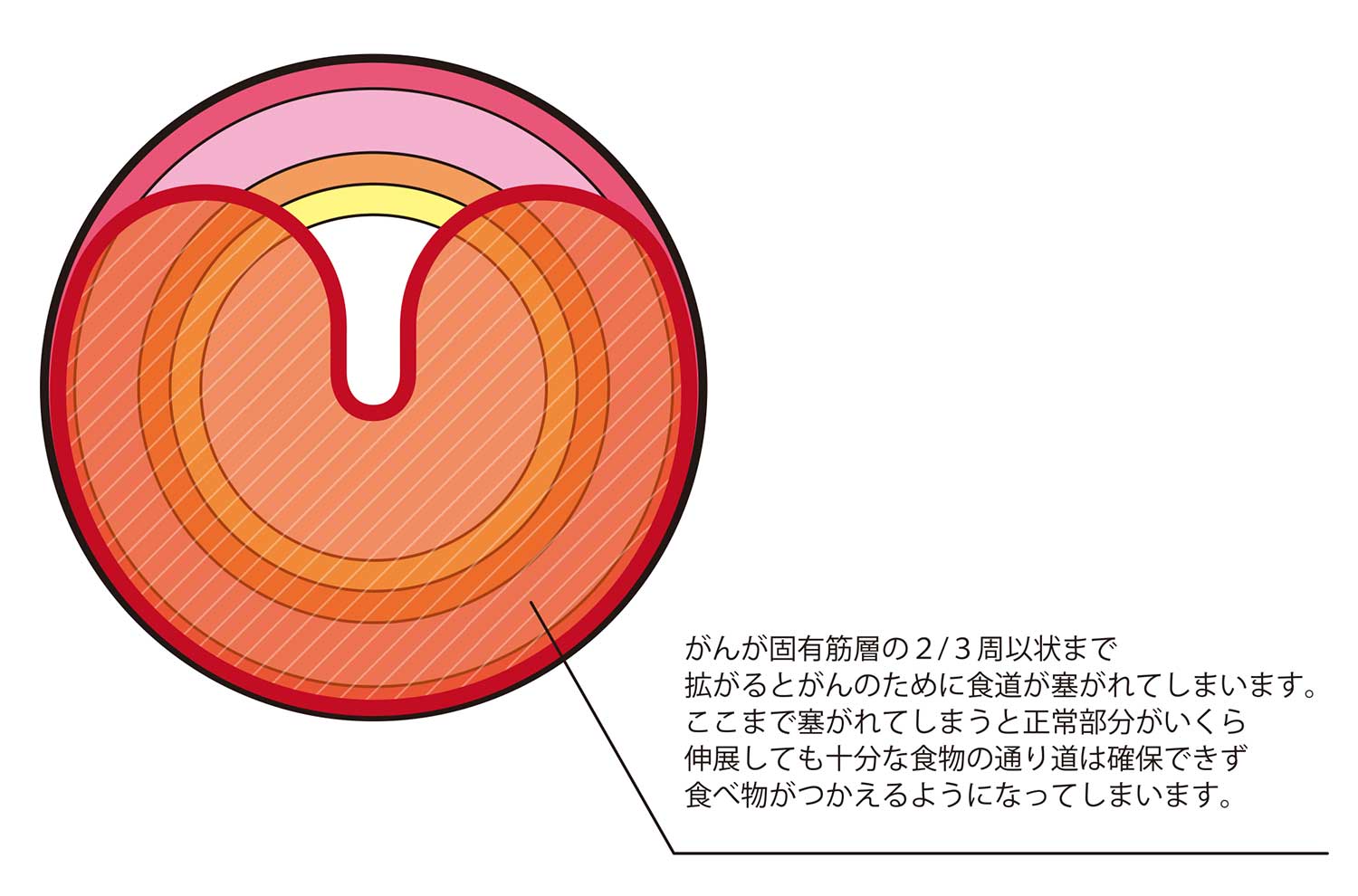 食道のがん組織の浸潤