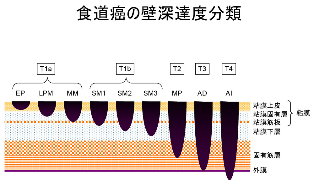 食道がんの壁深達度分類