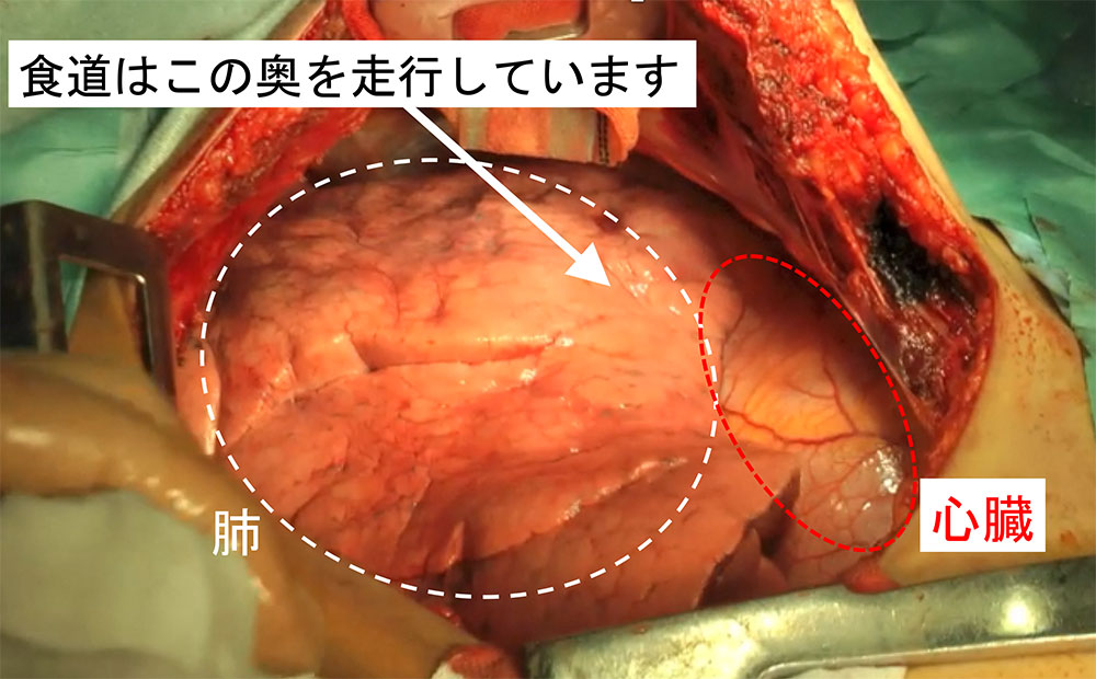 食道がんの手術