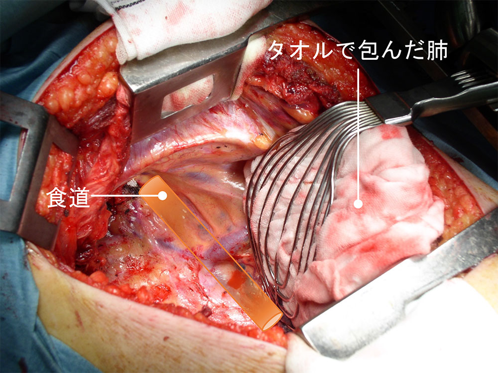食道がんの手術