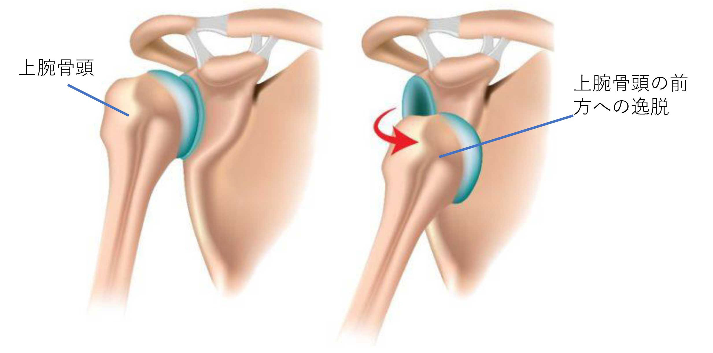 反復性肩関節脱臼 スポーツ医学科の主な疾患と治療方法 江戸川病院
