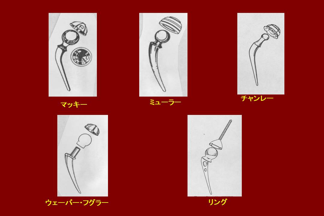 人工関節の原型