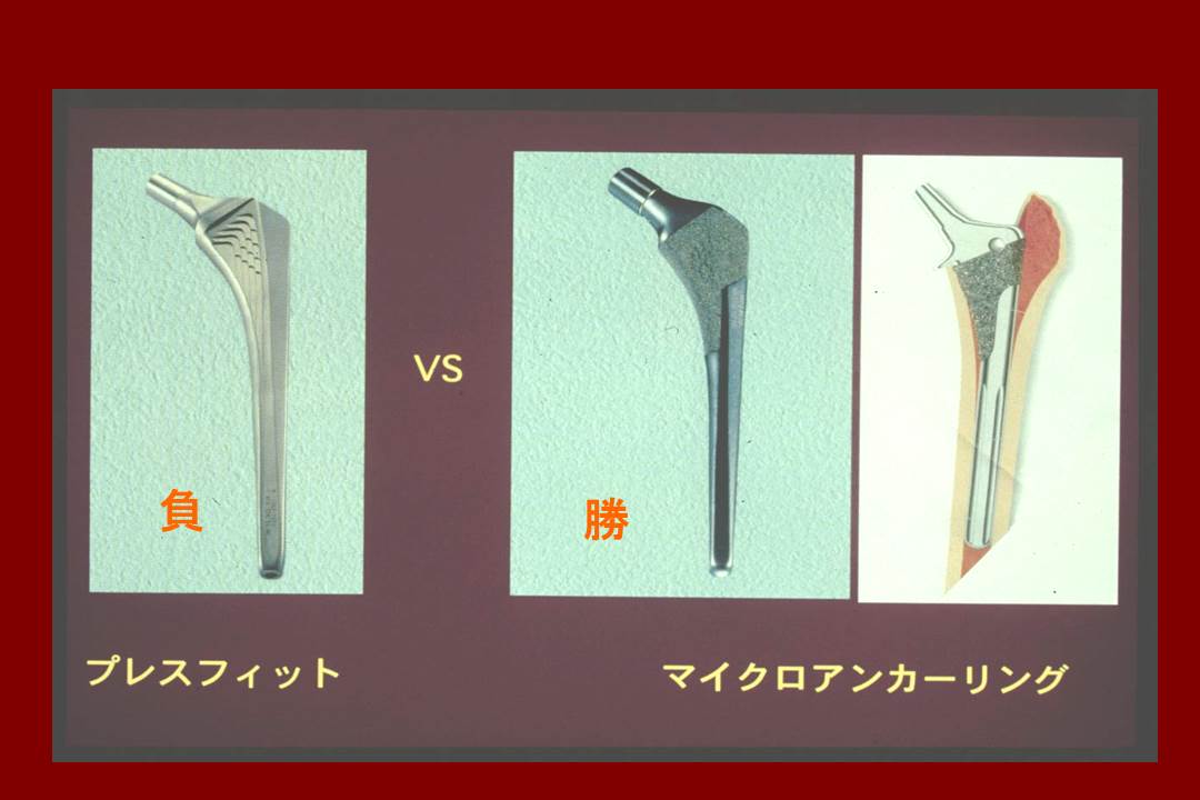 セメントレス人工股関節_マイクロアンカーリング間の優劣_近位固定vs遠位固定