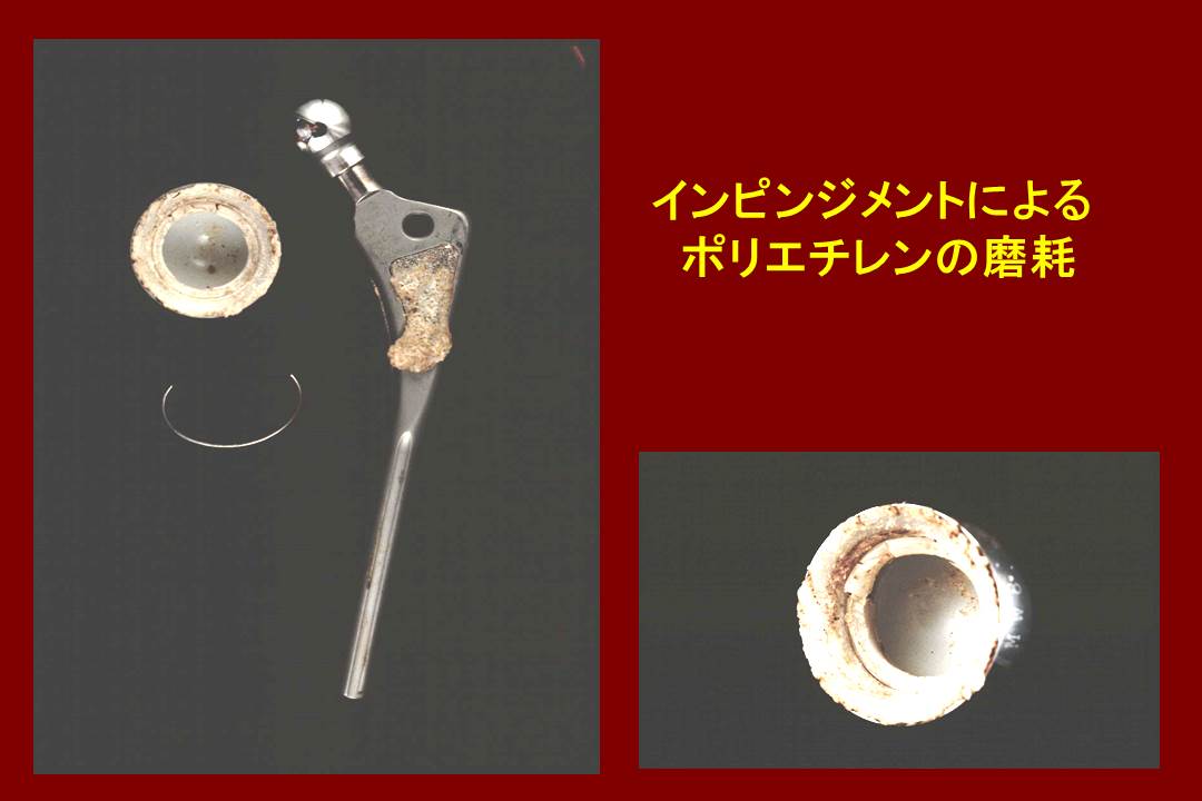 バイポーラー人工股関節vs従来型