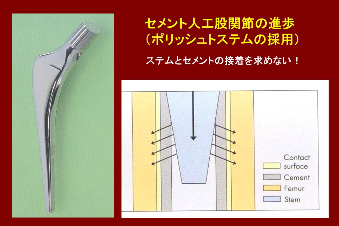 セメント人工股関節の進歩(ポリッシュトステムの採用)