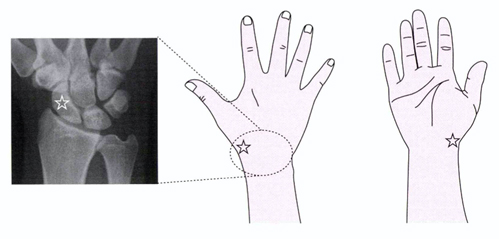 舟状骨骨折の圧痛点とレントゲン像