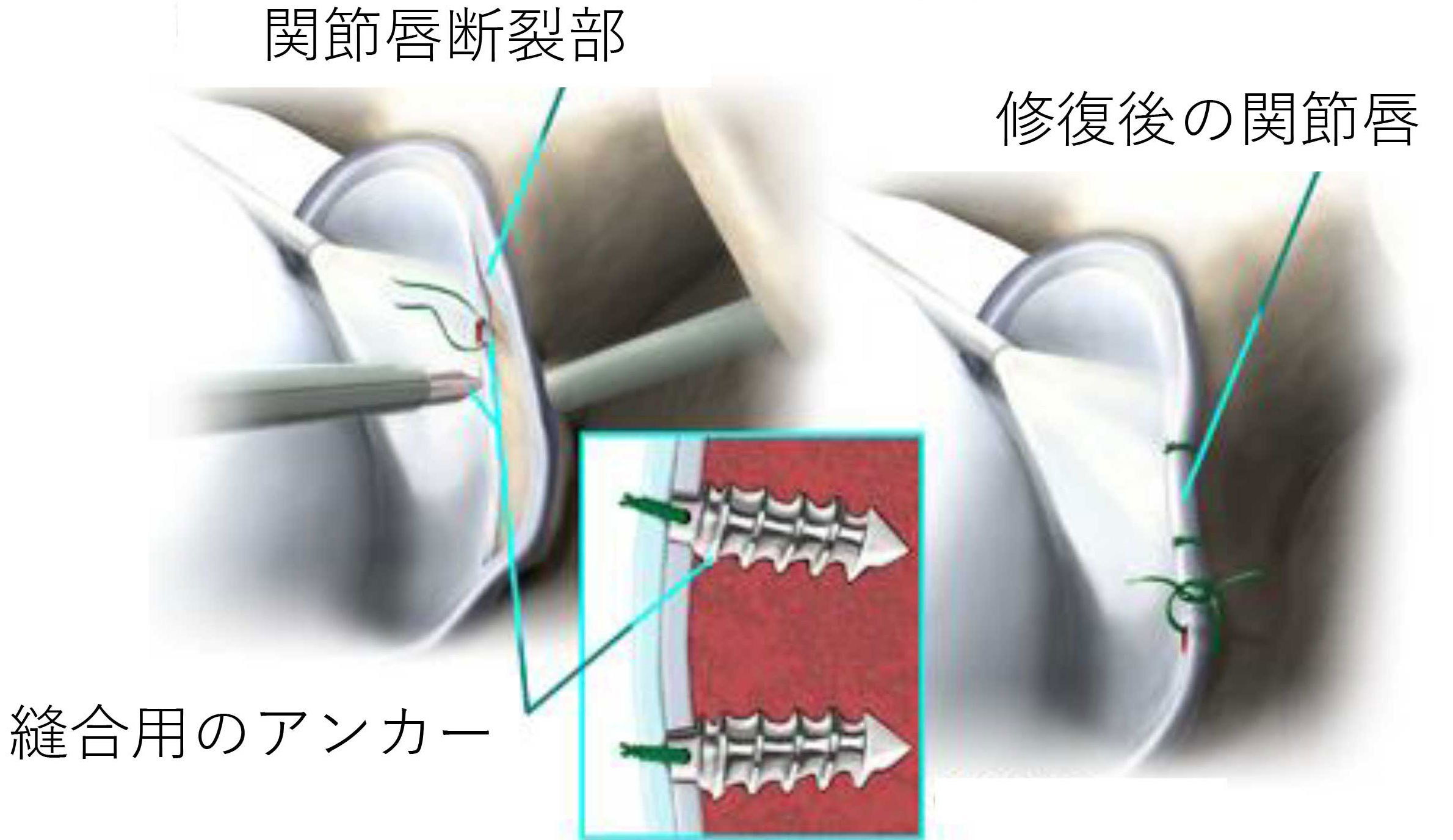 反復性肩関節脱臼 スポーツ医学科の主な疾患と治療方法 江戸川病院