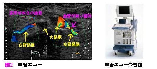 血管エコー